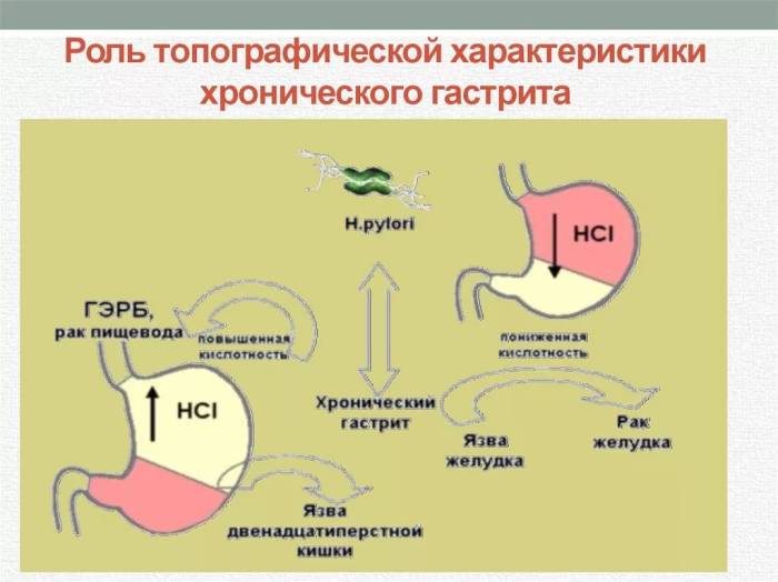 как определить гастрит с повышенной или пониженной кислотностью