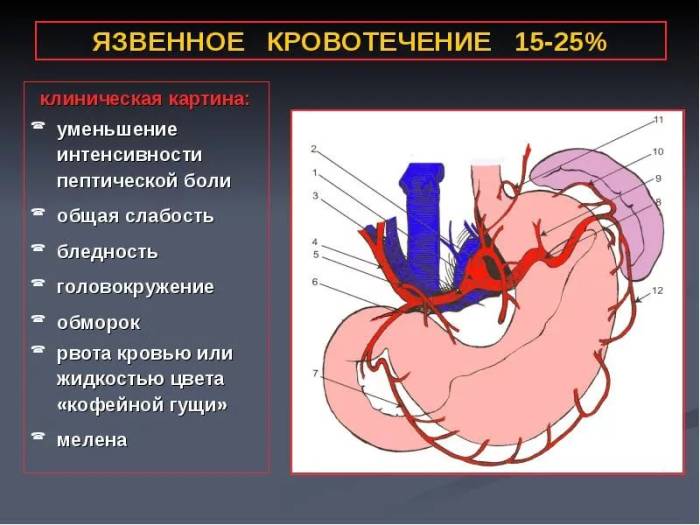 кровотечение при язве желудка