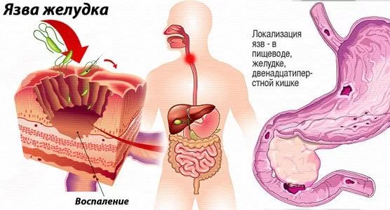 язва пищевода