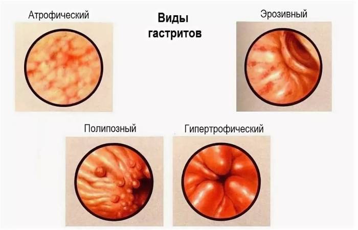 очаговый атрофический антральный гастрит