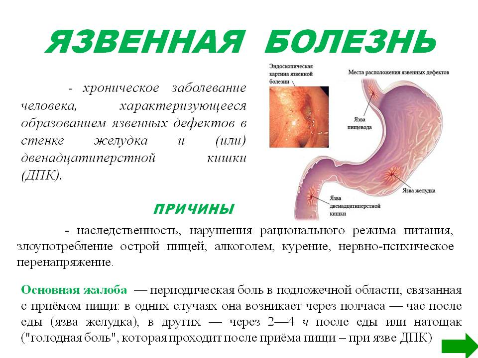 обострение язвы желудка