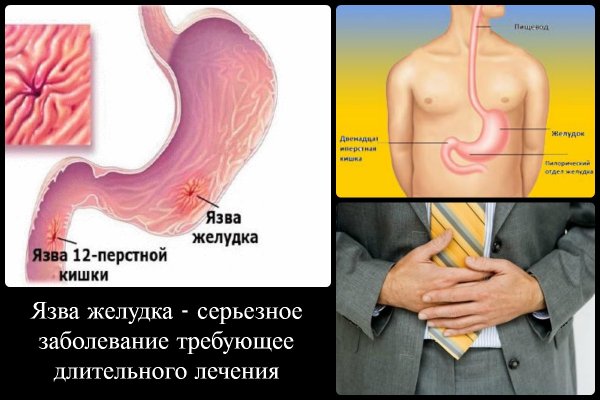 язва 12 перстной кишки симптомы и лечение народными средствами