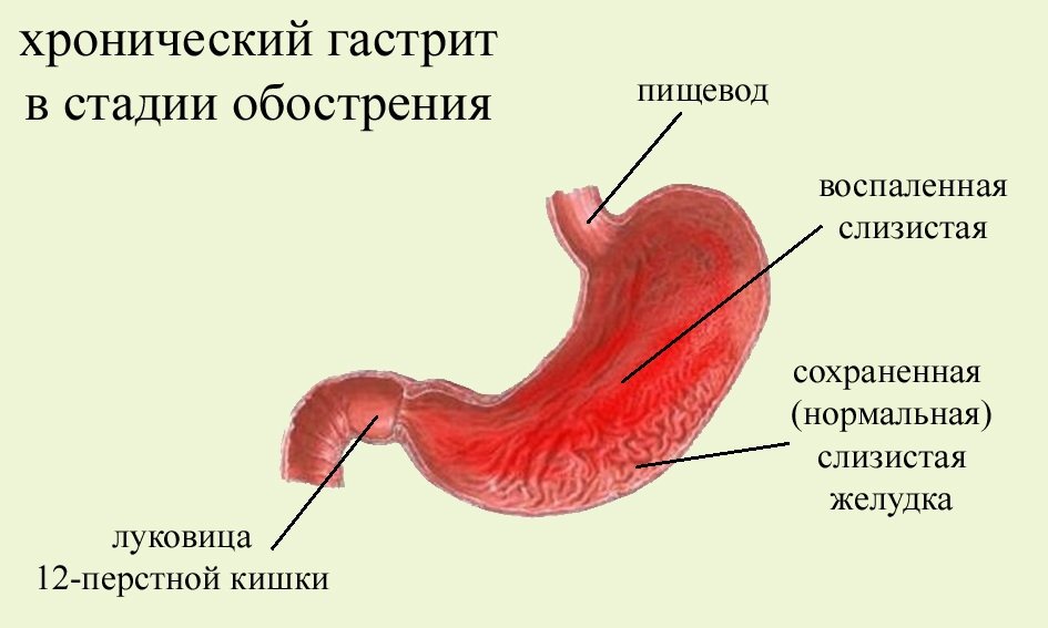 хронический гастрит лечение