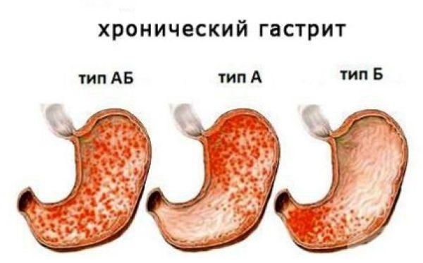 Хронический гастрит