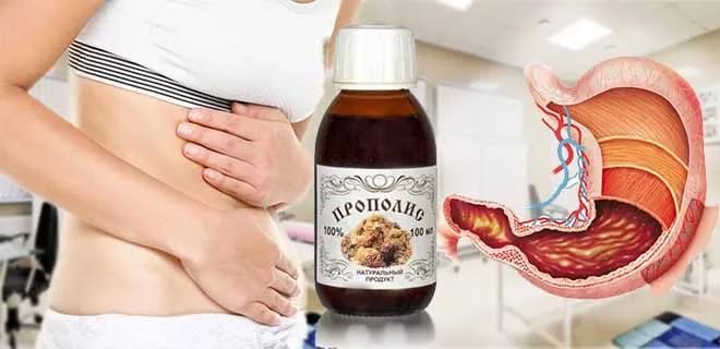 прополис при гастрите