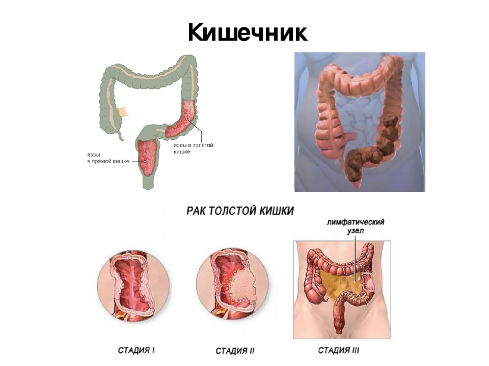 язва толстой кишки симптомы лечение