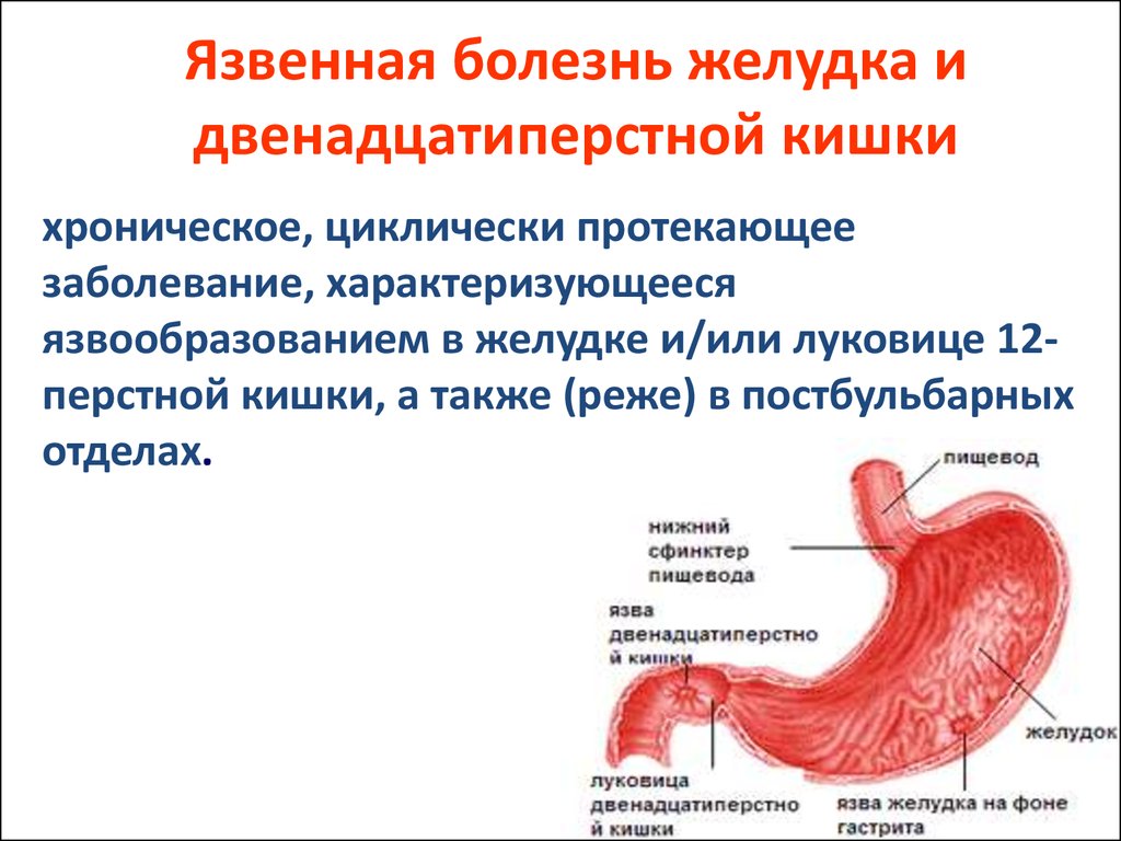 прободная язва 12 перстной кишки
