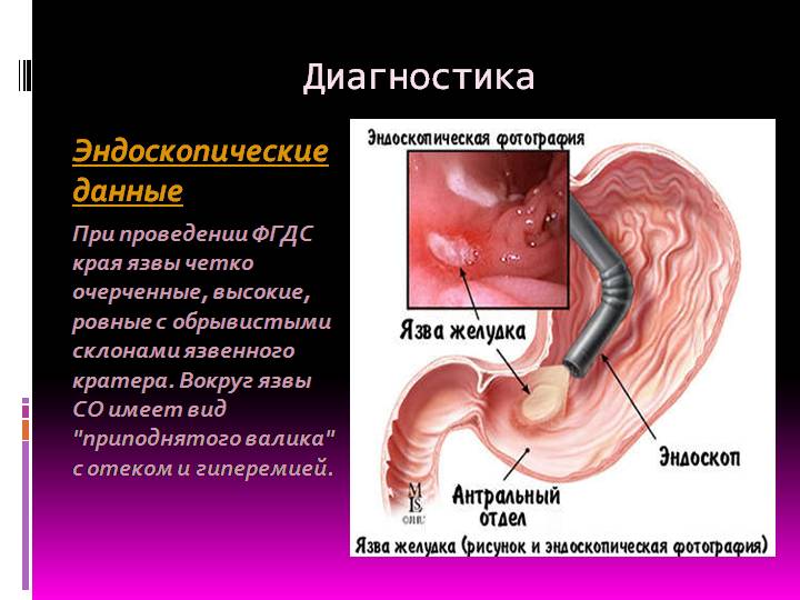прободная язва симптомы