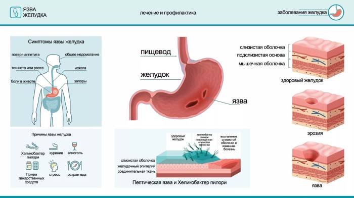 язва пищевода симптомы