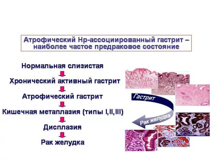 лечение хронического атрофического гастрита