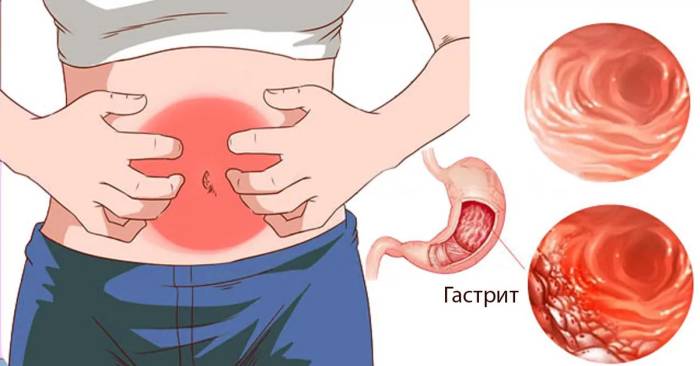 лечение гастрита с повышенной кислотностью народными средствами