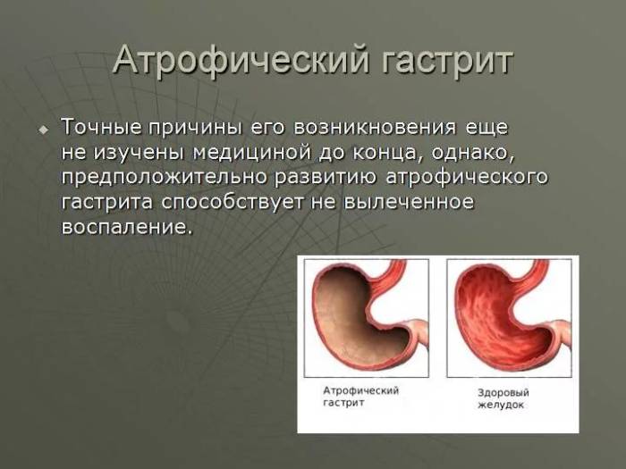 очаговый атрофический гастрит что это такое