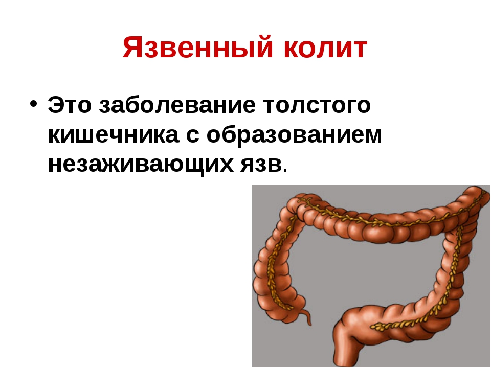 язва толстого кишечника