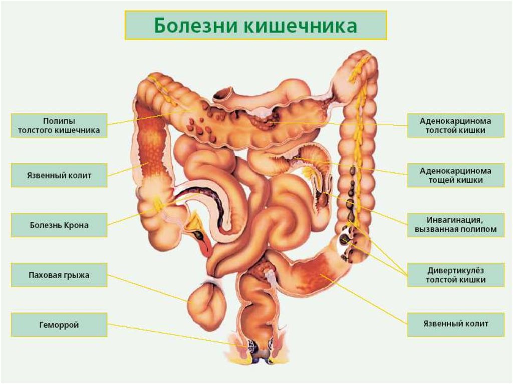 Болезни толстого кишечника