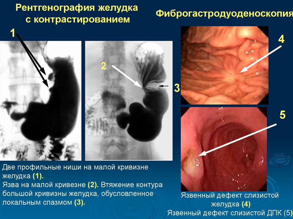 как диагностировать гастрит