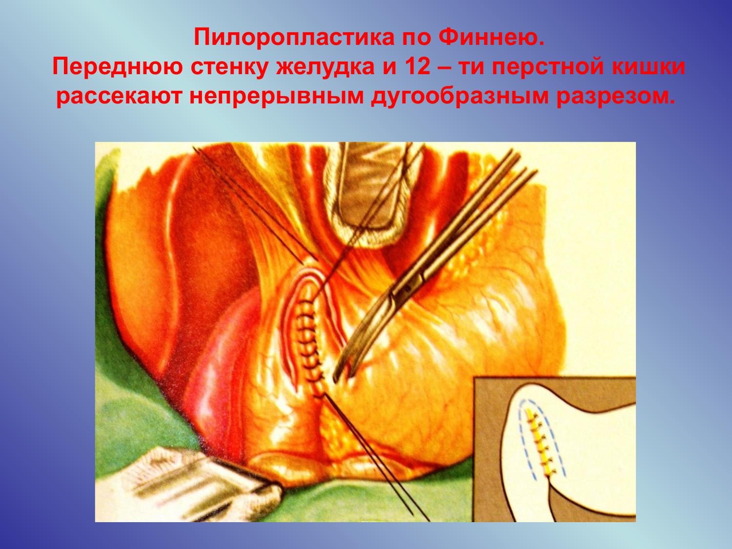прободная язва желудка