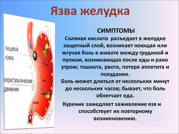 симптомы язвы желудка