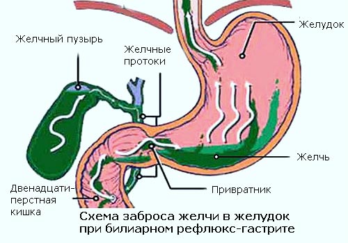 билиарный рефлюкс гастрит что это такое