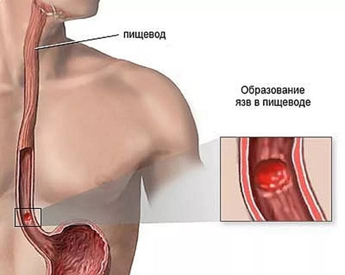 язва пищевода симптомы и лечение