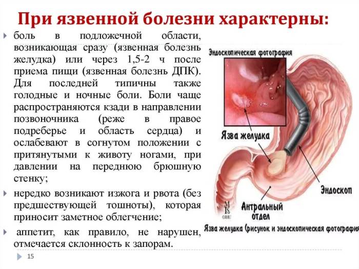 какие боли при язве желудка