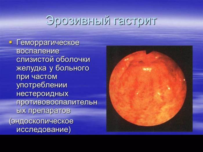 чем лечить эрозивный гастрит желудка