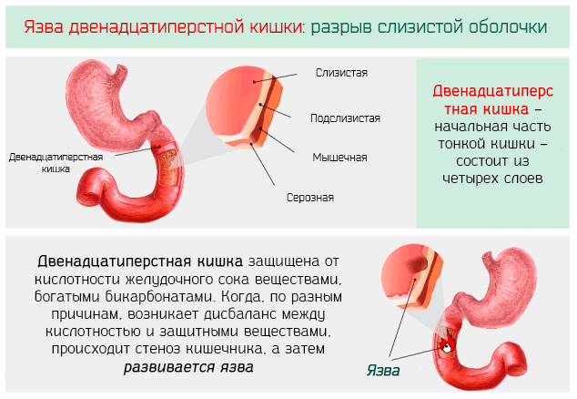 диета при язве 12 перстной кишки