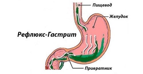 боли при гастрите симптомы