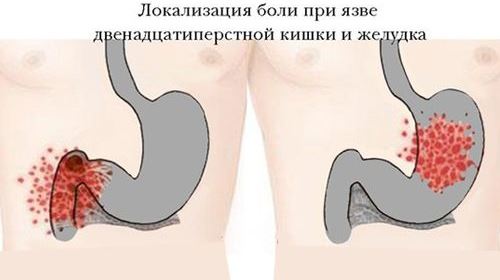язва 12 перстной кишки симптомы и лечение 