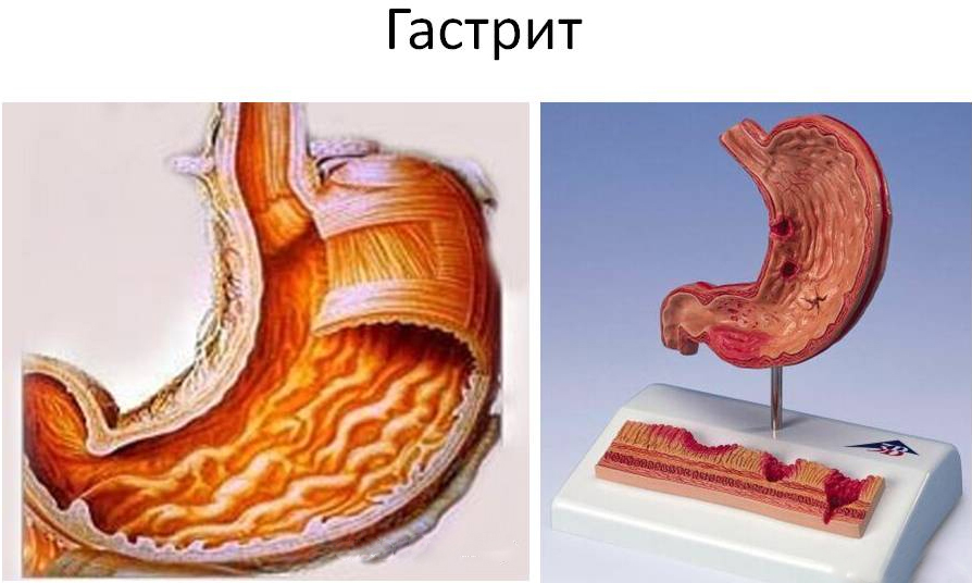 виды гастрита 