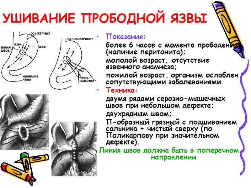 ушивание прободной язвы желудка
