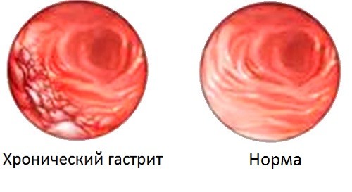 хронический гастрит
