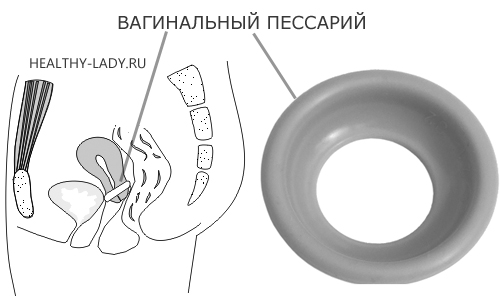 вагинальный пессарий