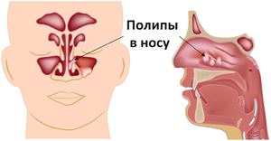 Что такое полипоз носа