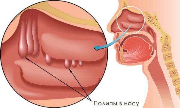 полипозный гайморит