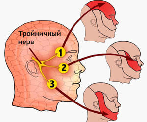 Какие признаки при воспалении нерва