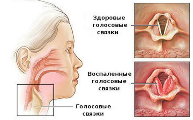 Теоретически при ларингите может болеть горло с одной стороны при поражении одной связки