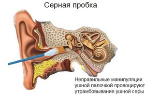 Как лечить пробку в ухе у детей