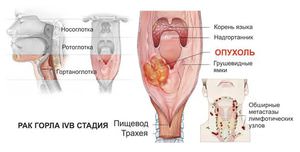 Симптомы опухоли горла
