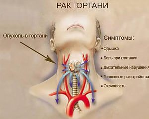 Как определить стадию заболевания