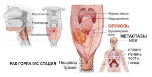 Как лечить опухоль горла
