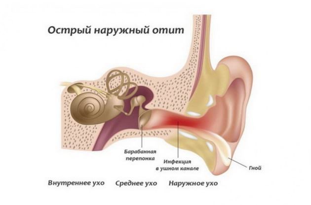 Лечение отита народными средствами