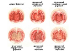 Формы фарингита