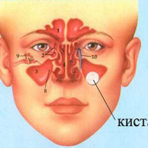Левостооняя верхнечелюстная киста