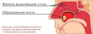 Обрзоание кисты у человека