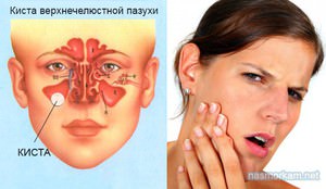 Приины образования кисты в организме