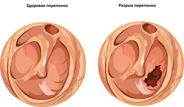 Дефект перепонки как причина боли