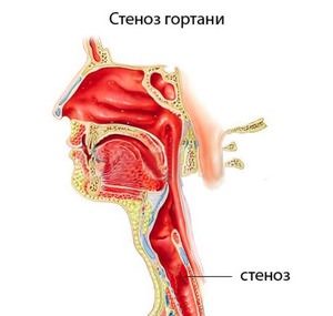 В чем опасность заболевания