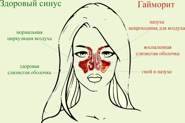 Гайморит
