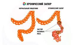 Дюфалак дешевые аналоги (список с ценами), какой препарат лучше