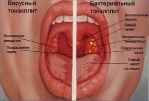 Больные миндалины